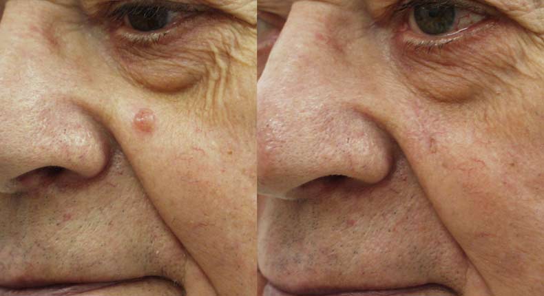 Excision Squamous Cell Carcinoma Face