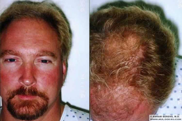 Hair Transplant Pictures