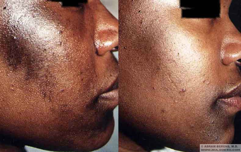 Before And After Microdermabrasion Pictures. Before and After Photos
