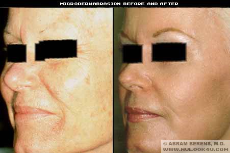 Retinol Before And After. Retin A Before And After