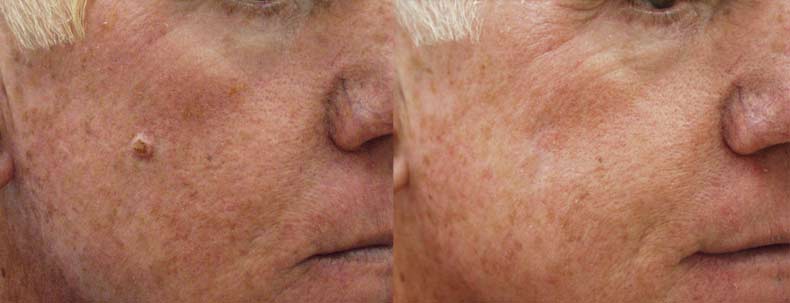 Aventura mole removal