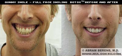 botox gummy smile