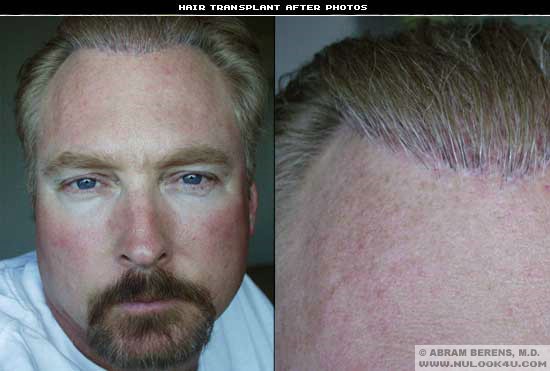 Hair Transplant Surgery - in Fort Lauderdale South Florida