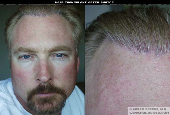 ft lauderdale hair transplant