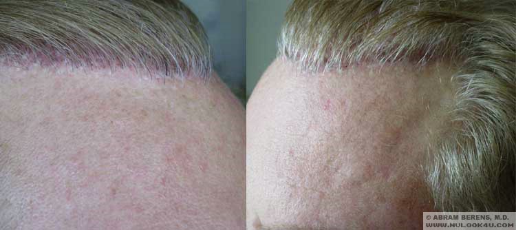 south florida Hair Transplant