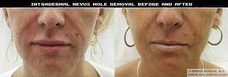 mole removal weston