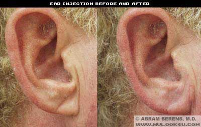 south fl restylane ear treatment