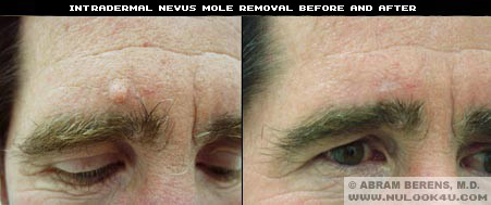 south florida mole removal