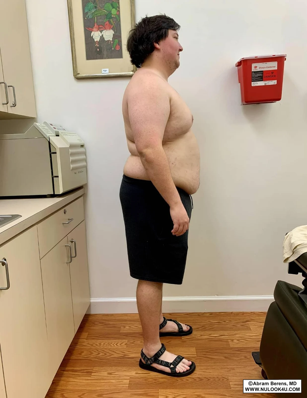 Medical weight loss patient before semaglutide treatment, side view