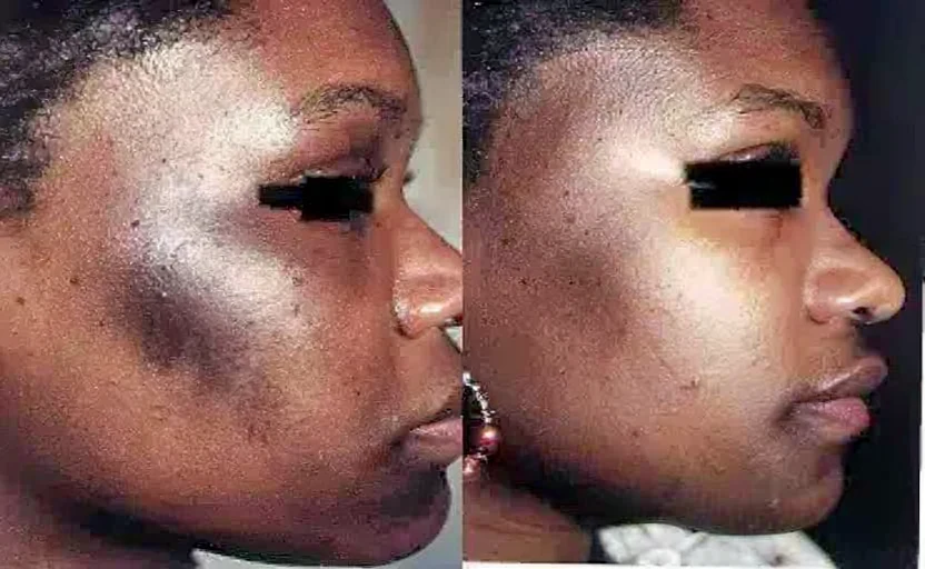 Skin resurfacing treatment, before-and-after patient photo (4 of 4)