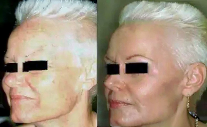 Skin resurfacing treatment, before-and-after patient photo (3 of 4)