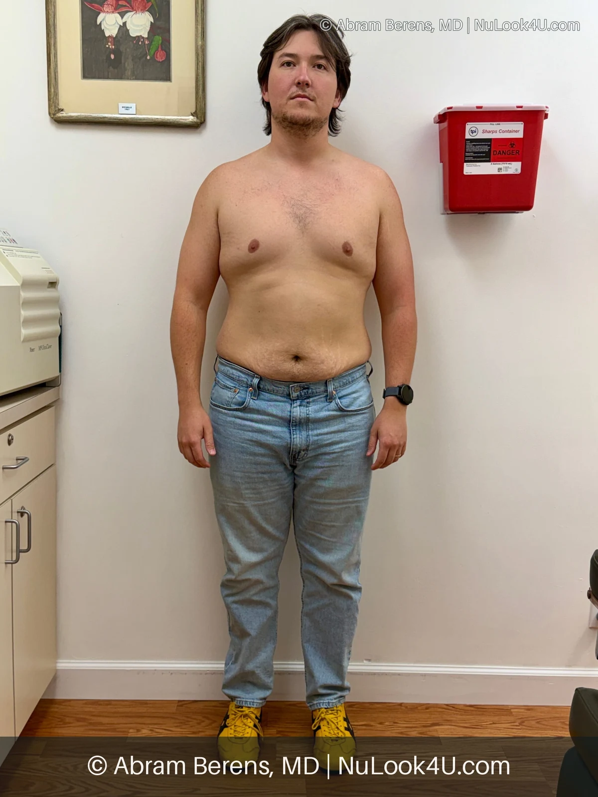 Medical weight loss patient, full-length front view (5 of 6)