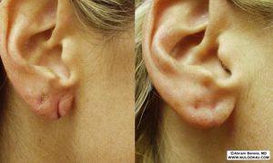 Earlobe repair, before-and-after patient photo (1 of 2)
