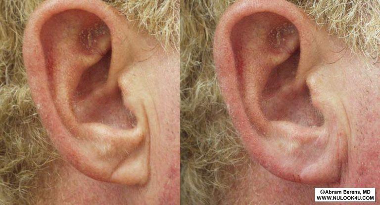 Earlobe repair, before-and-after patient photo (2 of 2)