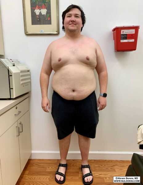 Medical weight loss patient before semaglutide treatment, front view