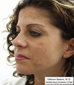Restylane filler treatment: left side of face, after treatment (4 of 27)