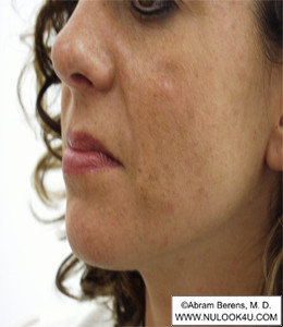 Restylane filler treatment: left nasolabial fold, after treatment (3 of 27)