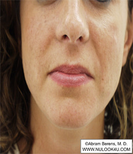 Restylane filler treatment: nasolabial folds, after treatment (2 of 27)