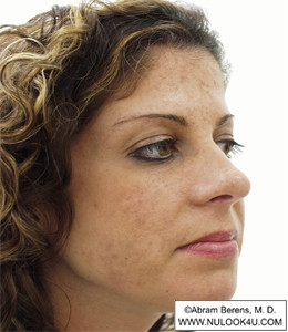 Restylane filler treatment: right side of face, after treatment (1 of 27)