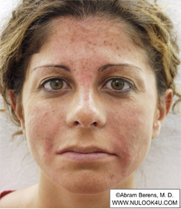 Restylane filler treatment: full face, after treatment (12 of 27)