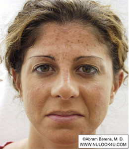 Restylane filler treatment: full face, before BOTOX and Restylane (11 of 27)