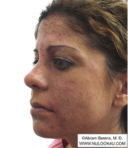 Restylane filler treatment: left side of face, after treatment (6 of 27)