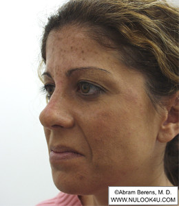 Restylane filler treatment: left side of face, before treatment (5 of 27)