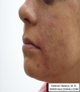 Restylane filler treatment: left nasolabial fold, after treatment (16 of 27)