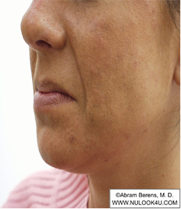 Restylane filler treatment: left nasolabial fold, before treatment (15 of 27)