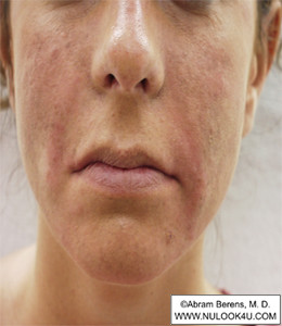Restylane filler treatment: nasolabial folds, after treatment (9 of 27)