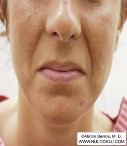 Restylane filler treatment: nasolabial folds, before treatment (10 of 27)