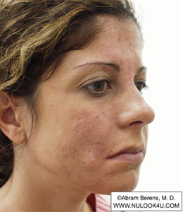 Restylane filler treatment: right side of face, after treatment (8 of 27)