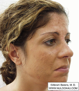 Restylane filler treatment: right side of face, before treatment (7 of 27)