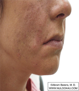 Restylane filler treatment: right nasolabial fold, after treatment (14 of 27)