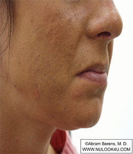 Restylane filler treatment: right nasolabial fold, before treatment (13 of 27)