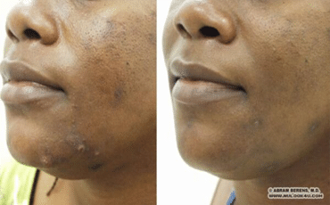 Acne treatment, before-and-after patient photo (1 of 3)