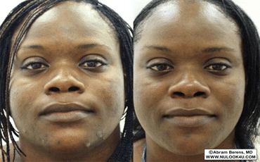 Acne treatment, before-and-after patient photo (2 of 3)