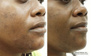 Acne treatment, before-and-after patient photo (3 of 3)