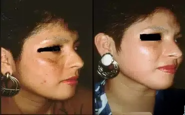 Chemical peel, before-and-after patient photo (4 of 4)