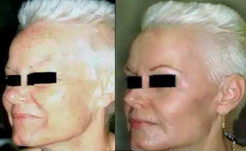 Chemical peel, before-and-after patient photo (2 of 4)