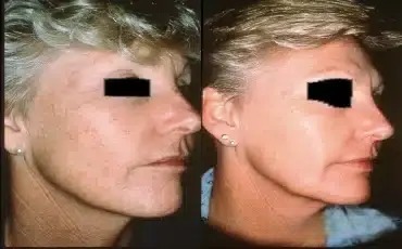 Chemical peel, before-and-after patient photo (3 of 4)
