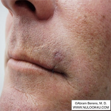 Scar revision surgery: upper lip, before surgery (2 of 6)