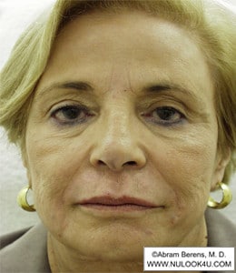 Restylane filler treatment: full face, nasolabial folds and lips, after treatment (24 of 27)