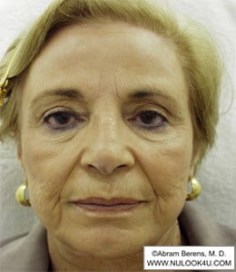 Restylane filler treatment: full face, before treatment (23 of 27)