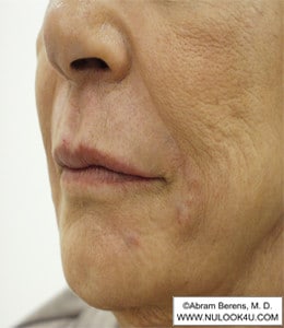 Restylane filler treatment: nasolabial folds and lips, left oblique view, after treatment (18 of 27)