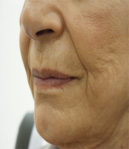 Restylane filler treatment: nasolabial folds and lips, left oblique view, before treatment (17 of 27)
