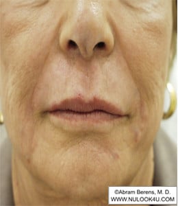 Restylane filler treatment: nasolabial folds and lips, after treatment (20 of 27)