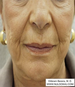 Restylane filler treatment: nasolabial folds and lips, before treatment (19 of 27)