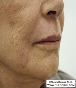 Restylane filler treatment: nasolabial folds and lips, right oblique view, after treatment (22 of 27)
