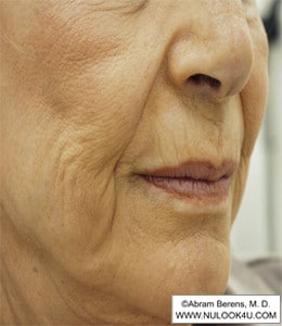 Restylane filler treatment: nasolabial folds and lips, right oblique view, before treatment (21 of 27)